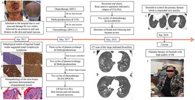 A first case of successful using of ibrutinib in treating paraneoplastic pemphigus related bronchiolitis obliterans concurrent with CLL